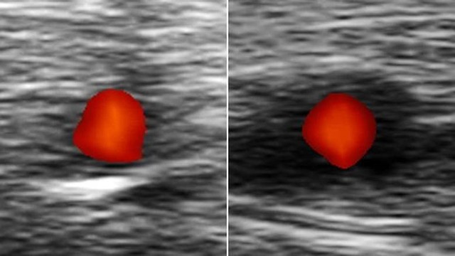 Como identificar sintomas da doença que causa cegueira repentina