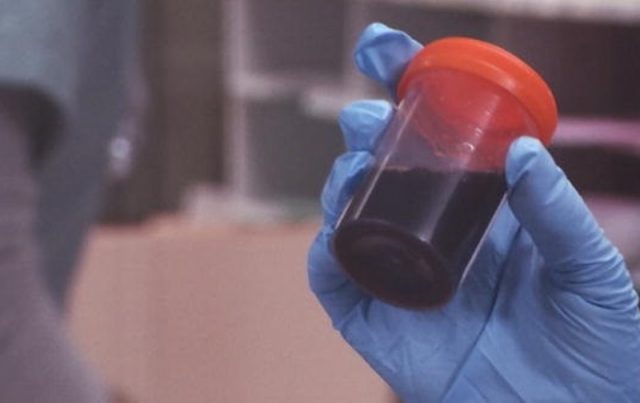 Pesquisadores descobrem a causa da doença da urina preta 