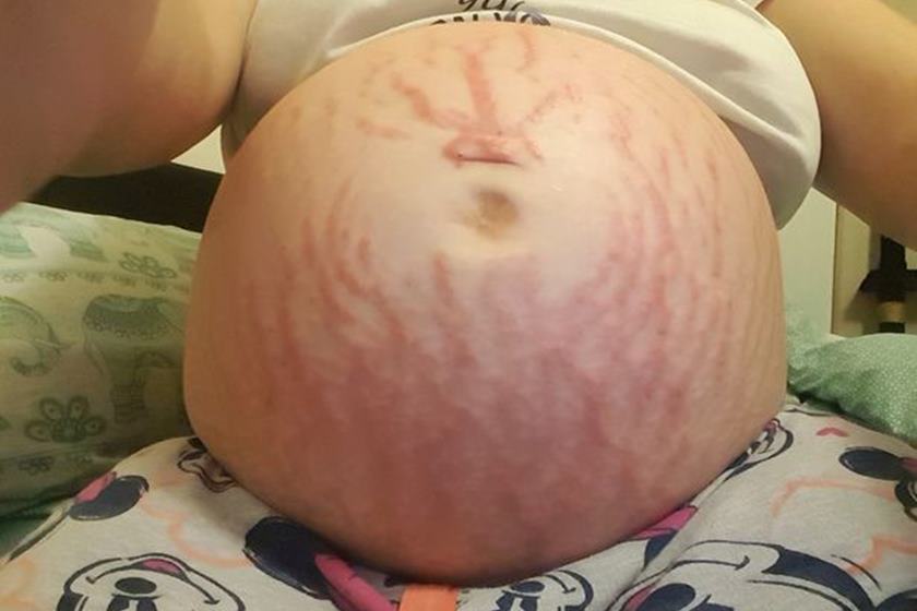 Grávida descobre que é alérgica à própria filha 