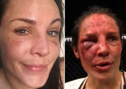 Após ficar desfigurada em combate, lutadora do UFC mostra recuperação
