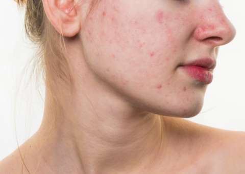 Babosa e Limão podem combater acnes e espinhas 