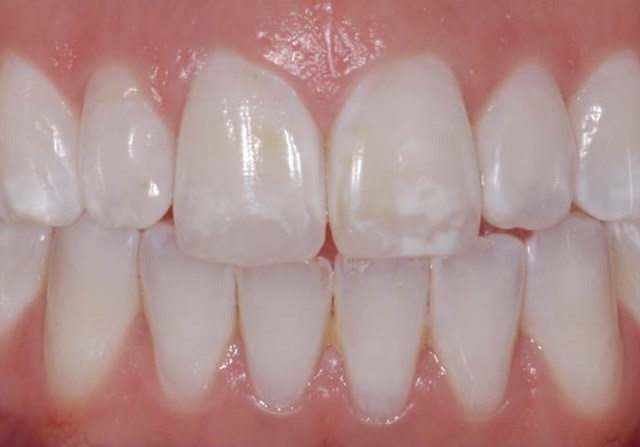 O que são as manchas brancas que algumas pessoas têm nos dentes?