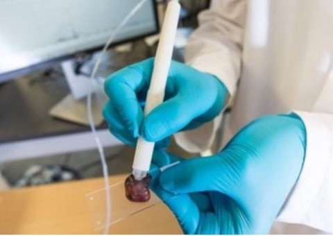 'Caneta' consegue identificar câncer em 10 segundos 