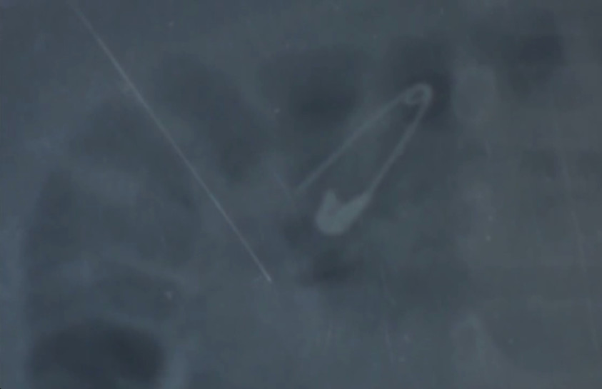 Bebê de seis meses engole alfinete aberto que prendia chupeta 