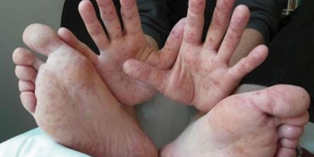 Cuidado com esse vírus que está se espalhando em escolas e creches; Saiba como evitar