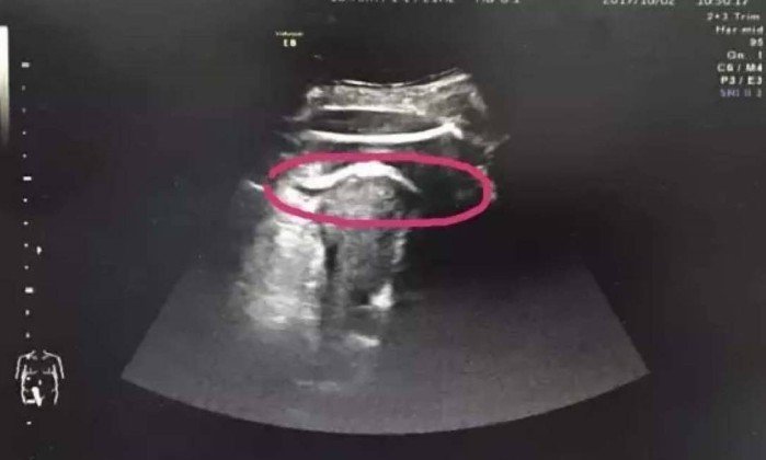 Mulher grávida quase morre após ‘chute’ do bebê romper o útero