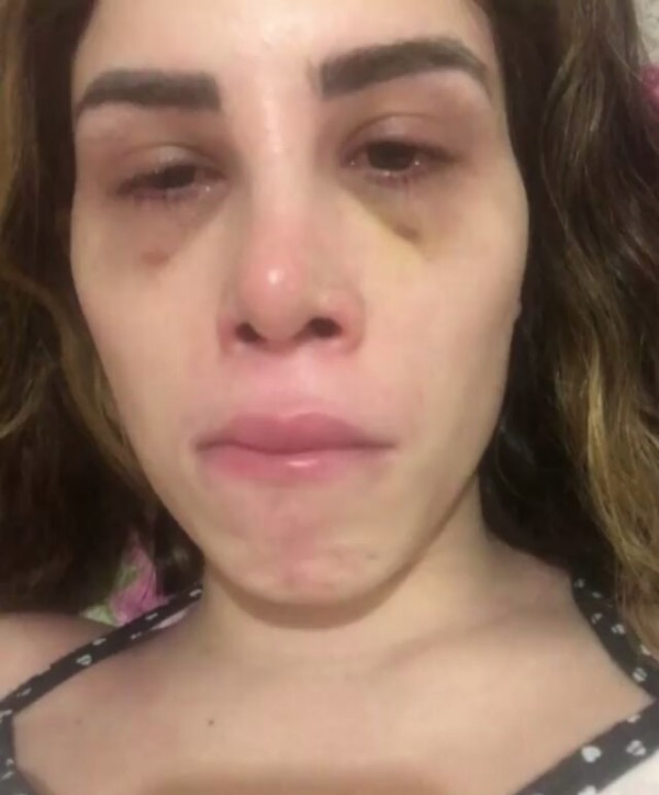 Youtuber Camila Uckers mostra corpo deformado após complicação com prótese de silicone 