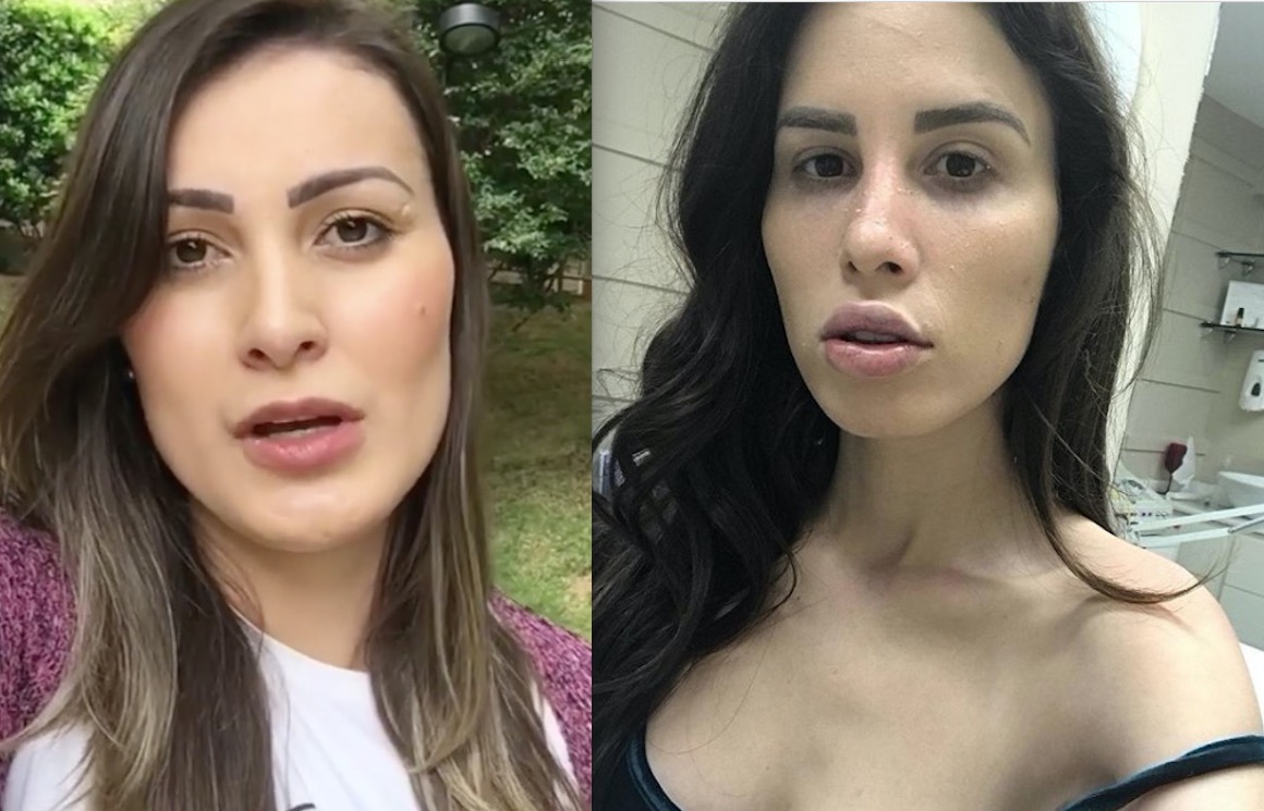 Irreconhecível, youtuber que sofreu infecção por silicone recebe ligação de Andressa Urach