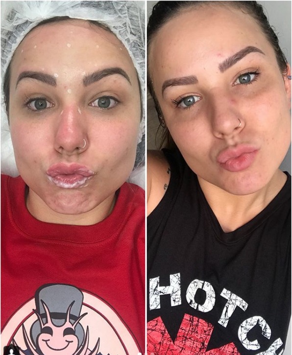 Ex-BBB Maria Claudia mostra resultado de botox e preenchimento labial