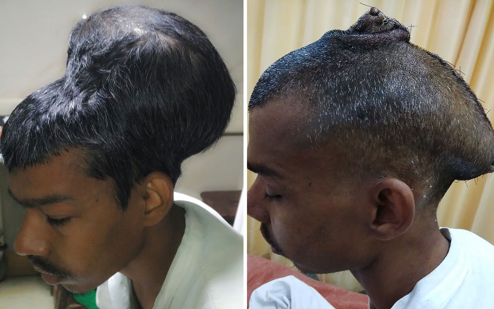 Homem passa por extração de tumor cerebral de 2 kg e resultado impressiona médicos