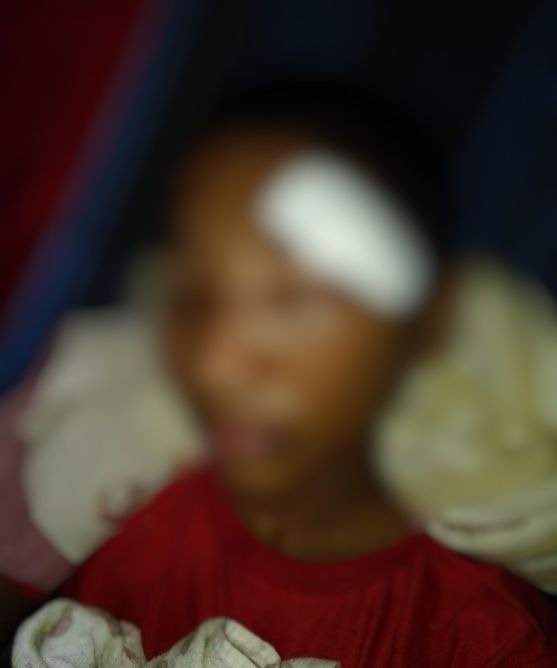 Brincadeira entre estudantes termina com aluno passando por cirurgia no rosto no Amazonas