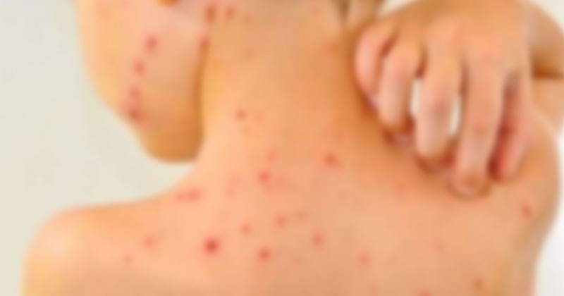 Sobe para 17 o número de suspeitas de Sarampo em Manaus