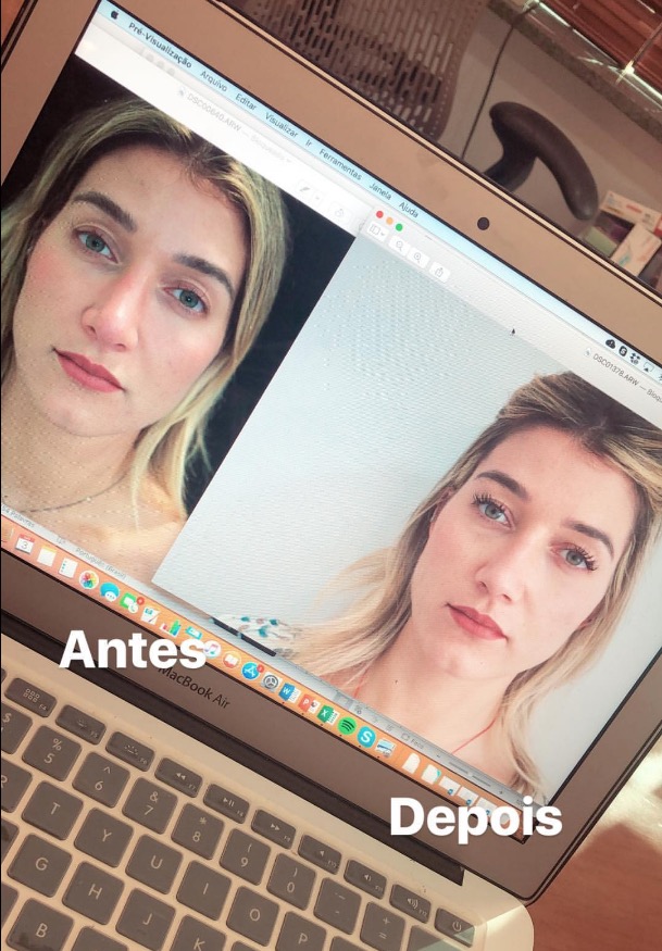 Gabriela Pugliesi mostra antes e depois de cirurgia no nariz