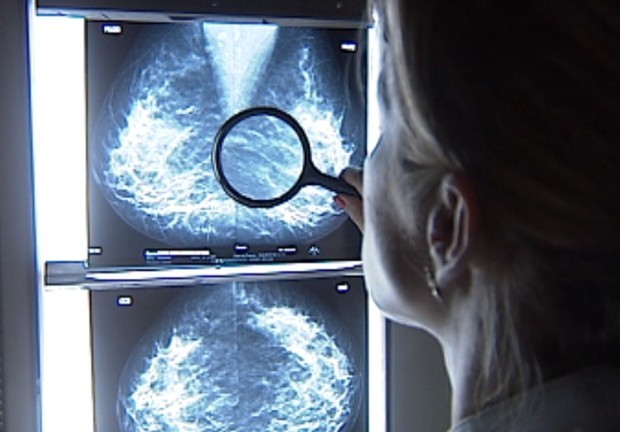 Cientistas descobrem composto capaz de bloquear metástases de cânceres  