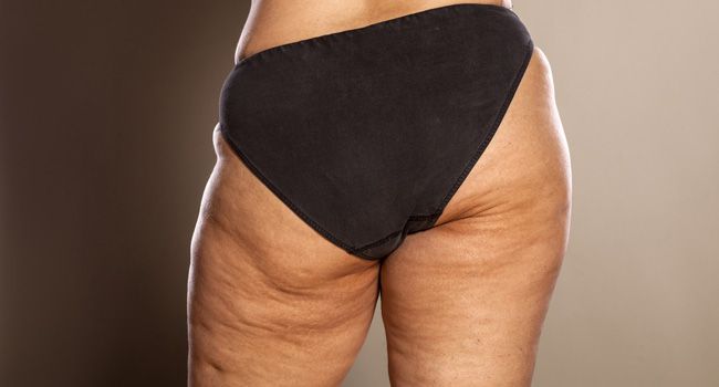 Veja 5 alimentos e porque evitá-los se você quer acabar com a celulite