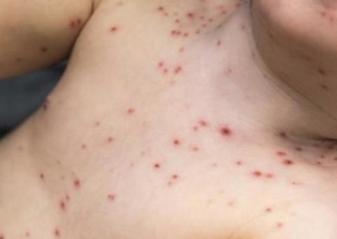 4ª morte por sarampo é confirmada no Amazonas