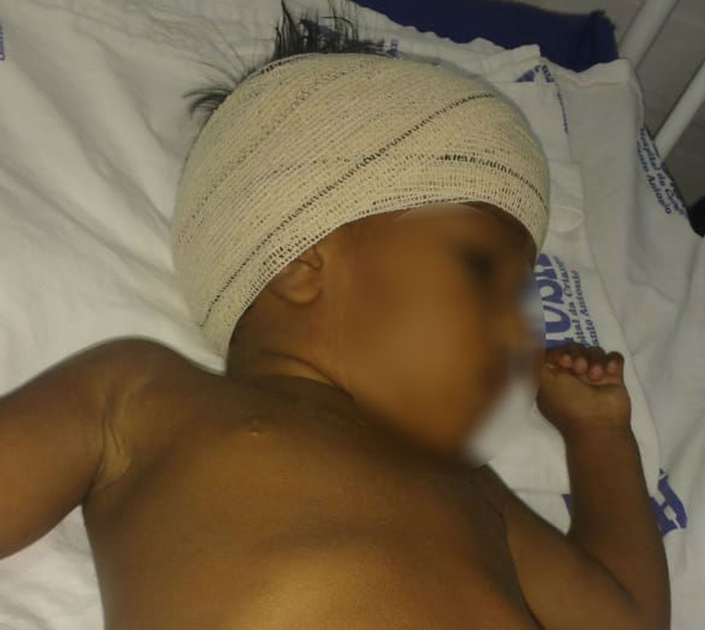 Bebê de dois anos é atacado por Pit Bull enquanto brincava na frente de casa