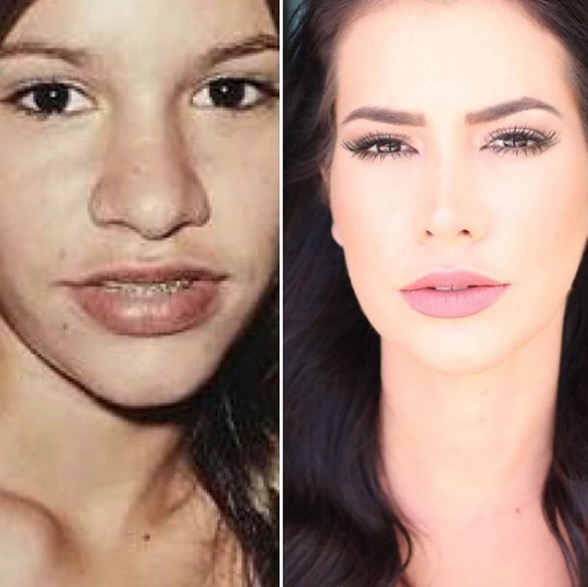  Ex-BBB Adriana aparece irreconhecível em foto antes de 2 cirurgias no nariz