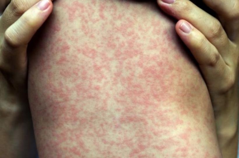 Novo boletim epidemiológico confirma redução de casos suspeitos de sarampo em Manaus