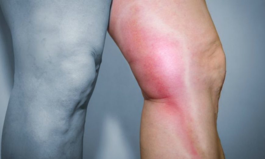 Voos longos podem provocar trombose e até embolia pulmonar