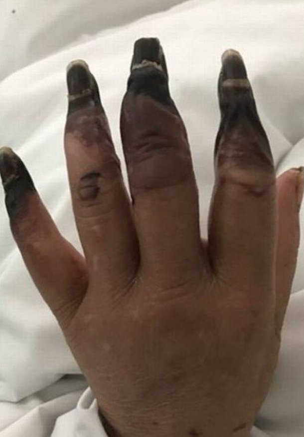 Dedos de mulher começam a apodrecer após corte pequeno durante faxina