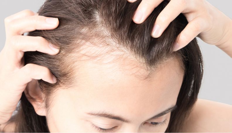 Mitos e verdades sobre a queda de cabelo e calvice precoce 
