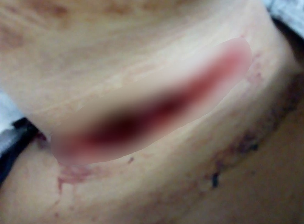 Motociclista leva 19 pontos no pescoço após ser atingida por linha de cerol