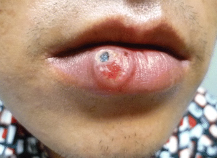 Epidemia Nacional: Especialista alerta para proteção contra Sífilis no Carnaval