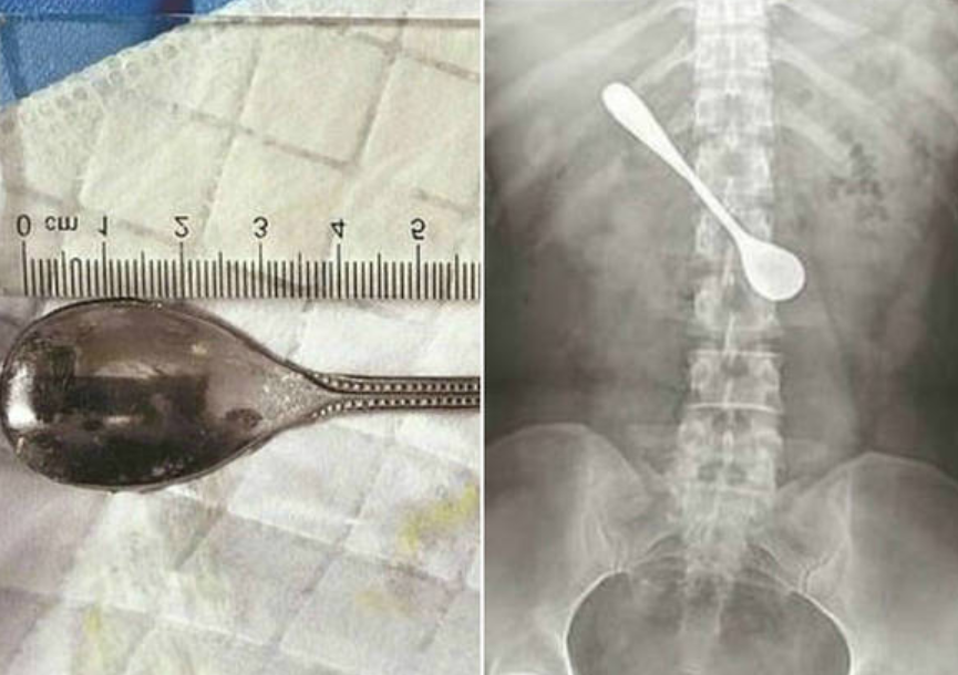 Mulher fica com colher no intestino após engasgar com peixe 