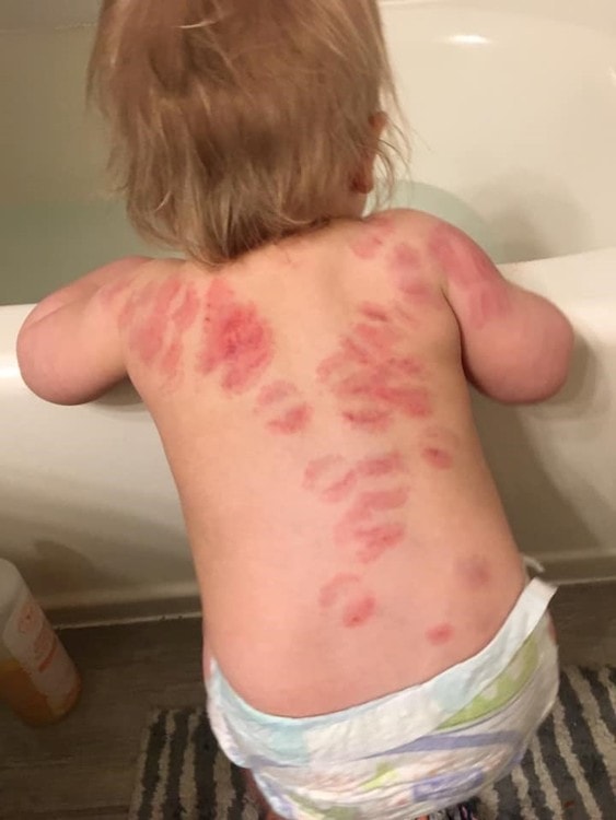 Bebê de 1 ano é mordido mais de 20 vezes em creche