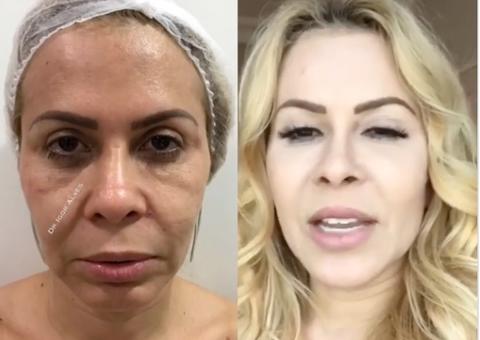 Médico mostra antes e depois da harmonização facial de Joelma