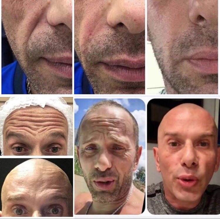 Rafael Ilha mostra antes e depois de botox e harmonização facial