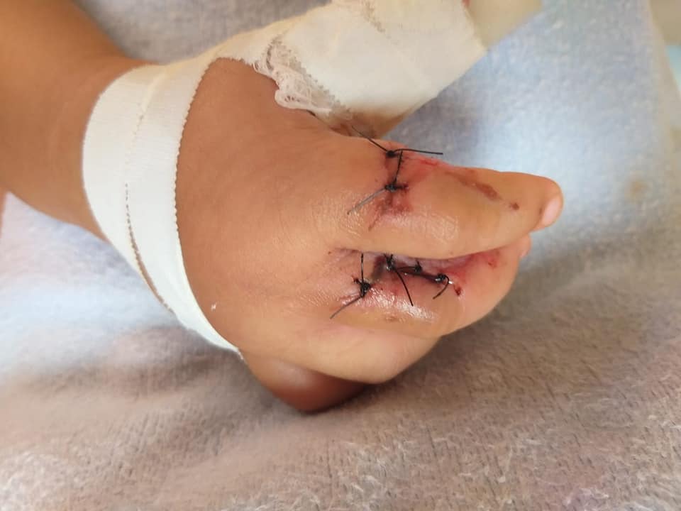 Criança tem mão esmagada em escada rolante de shopping de Manaus 