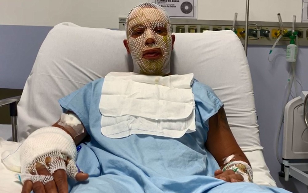 Prefeito e esposa feridos na explosão de fogueira por pouco não ficaram cegos