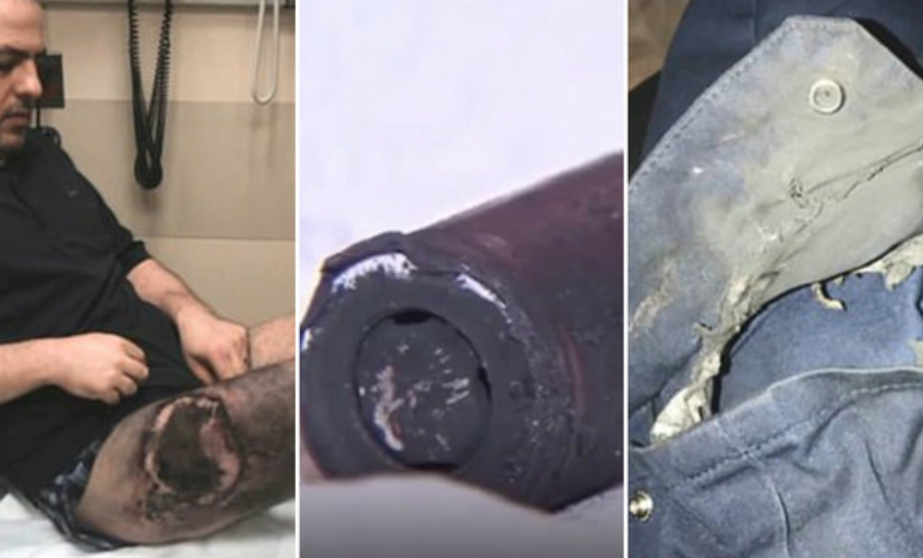 Homem sofre queimaduras após explosão de cigarro eletrônico em bolso 