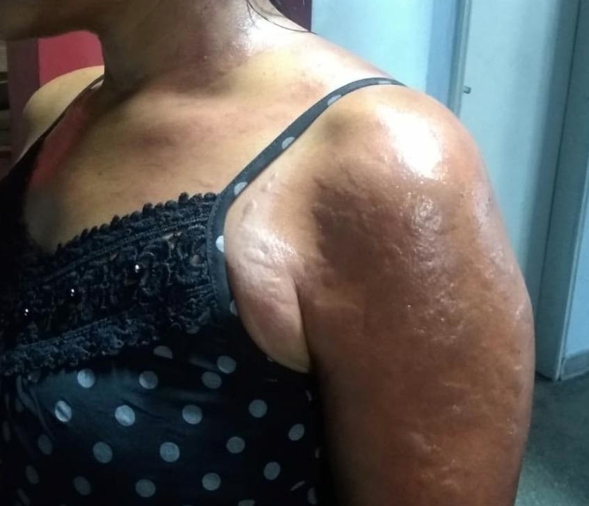 Em Manaus, marido é preso após jogar óleo quente na própria esposa durante discussão