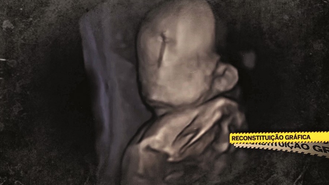 Bebê nasce sem rosto e pais denunciam negligência médica 