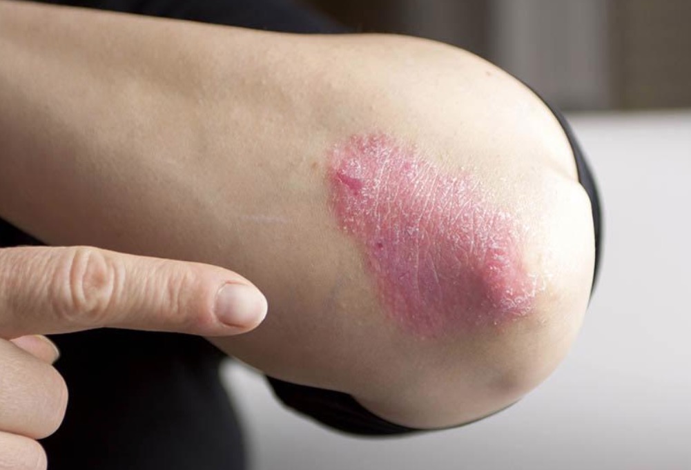 Dia mundial da Psoríase: especialista alerta que doença não é contagiosa