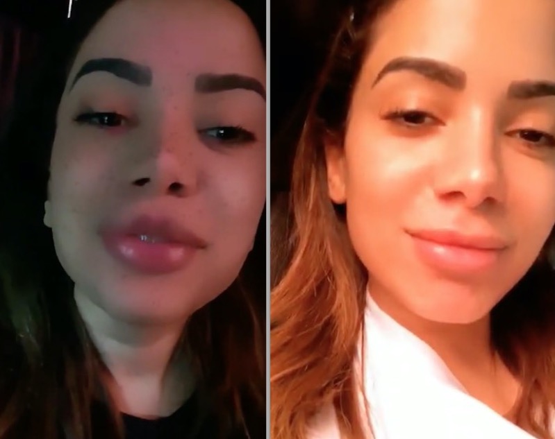 Anitta faz preenchimento labial para ficar igual a filtro do Instagram