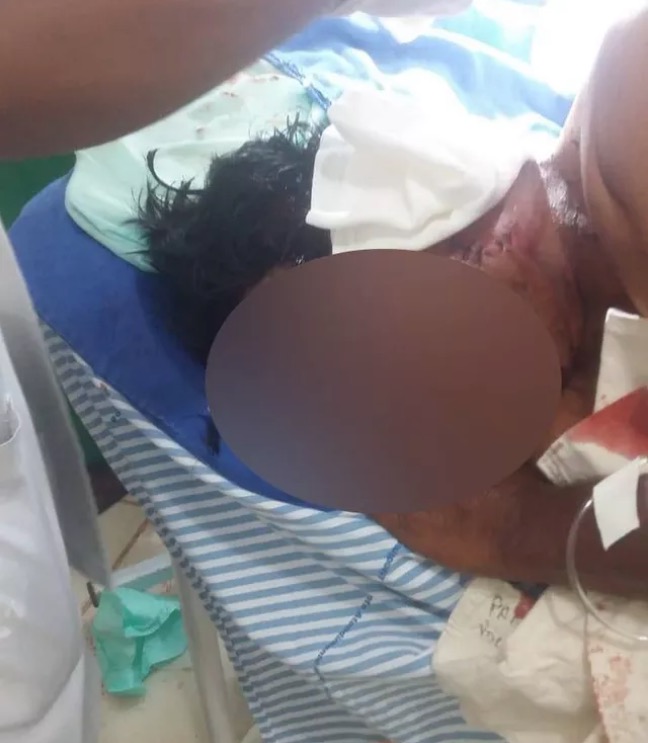 Homem tem rosto desfigurado por ataque de onça