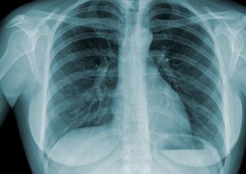 Dia Nacional de Combate à Tuberculose alerta para causas e riscos da doença