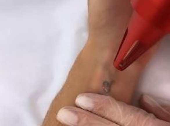 Juju Salimeni remove tatuagem com o nome de Felipe Franco após separação 