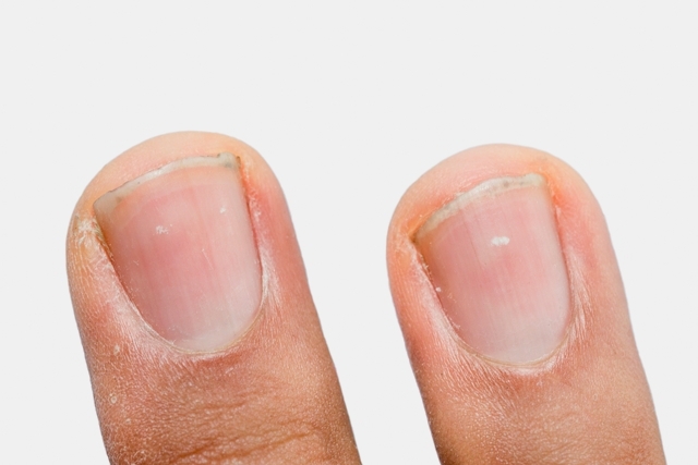 Veja o que pode ser mancha branca na unha e como tratar