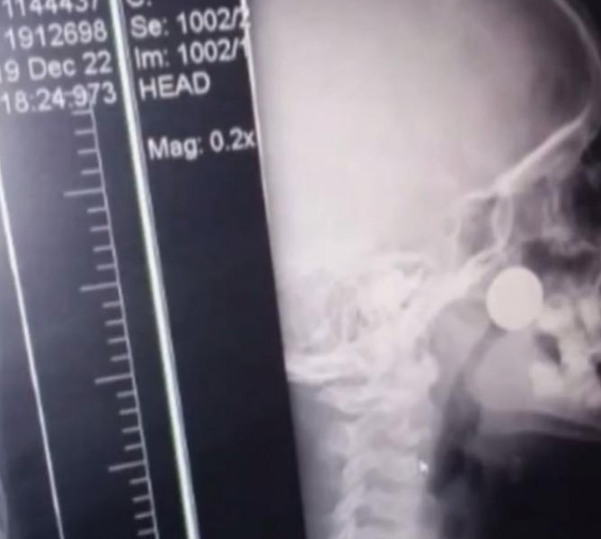 Menino fica dois dias com moeda presa dentro do nariz e retirada é feita após espirro