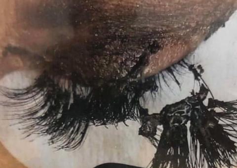 Cílios postiços podem causar queimaduras durante exame