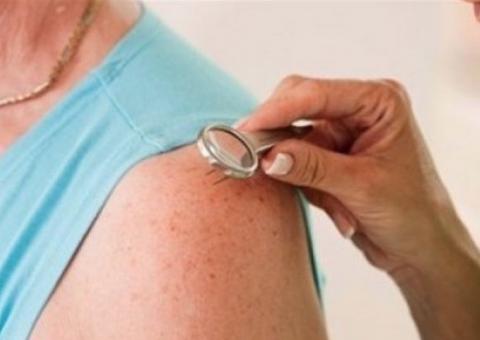 Campanha sobre a hanseníase começa com exames e consultas nesta terça em Manaus