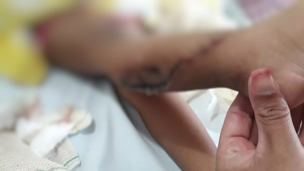 Criança de 3 anos sofre corte na perna em escada rolante de shopping