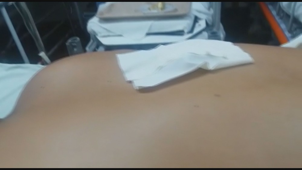 Paciente com faca cravada nas costas esperou 44 h por cirurgia em rede pública 
