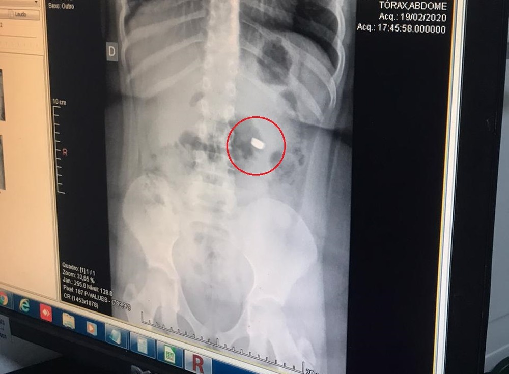 Criança é internada após engolir bateria de lanterna