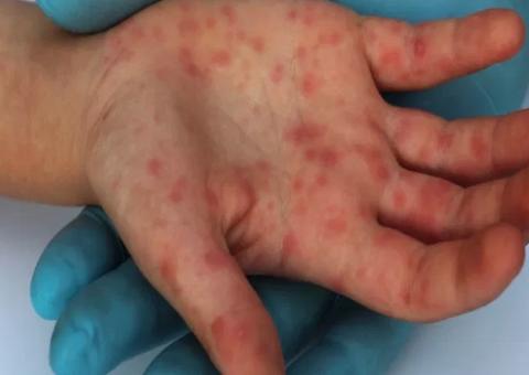 Em Manaus, bebê e outras três pessoas são diagnosticadas com sarampo